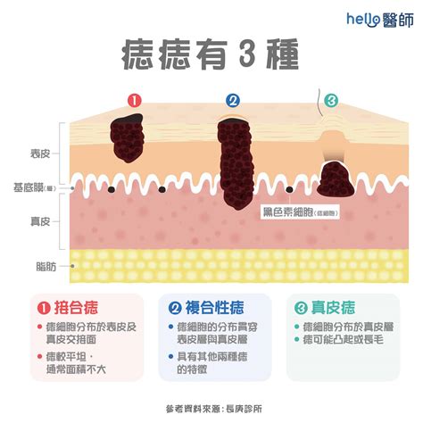 會長大的痣|痣是什麼？一次了解痣原因、就醫時機以及如何改善